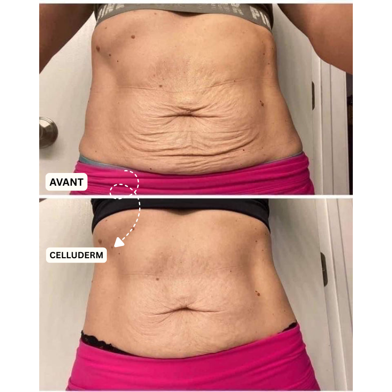 Derma+ Huile massage anti-cellulite