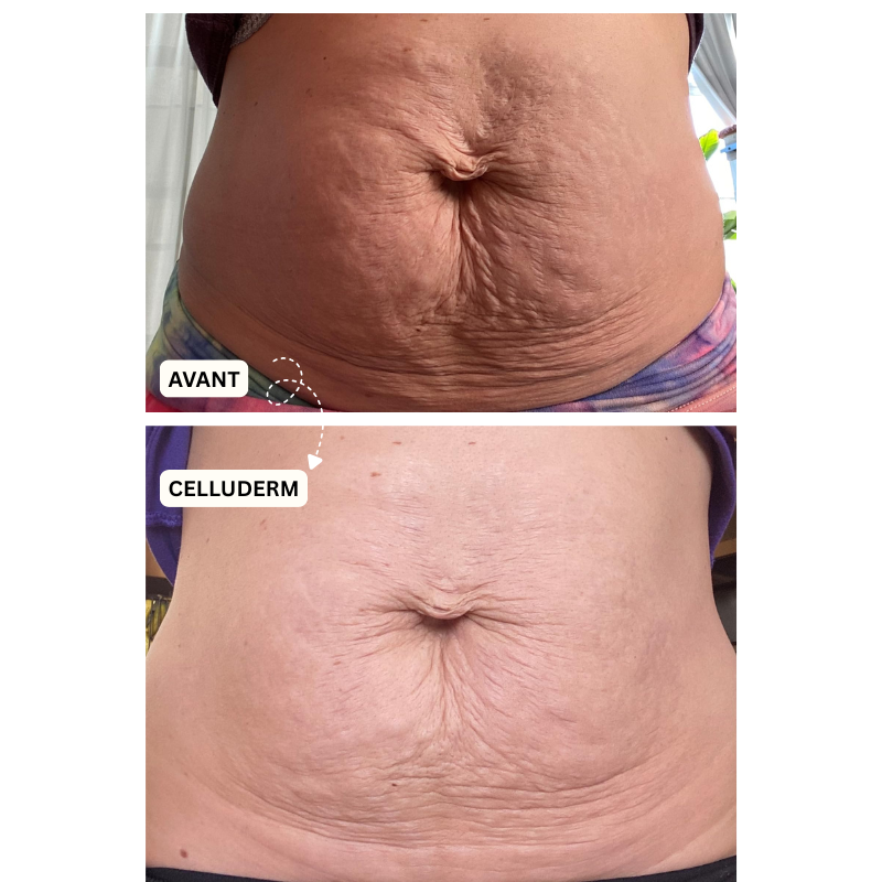 Derma+ Huile massage anti-cellulite