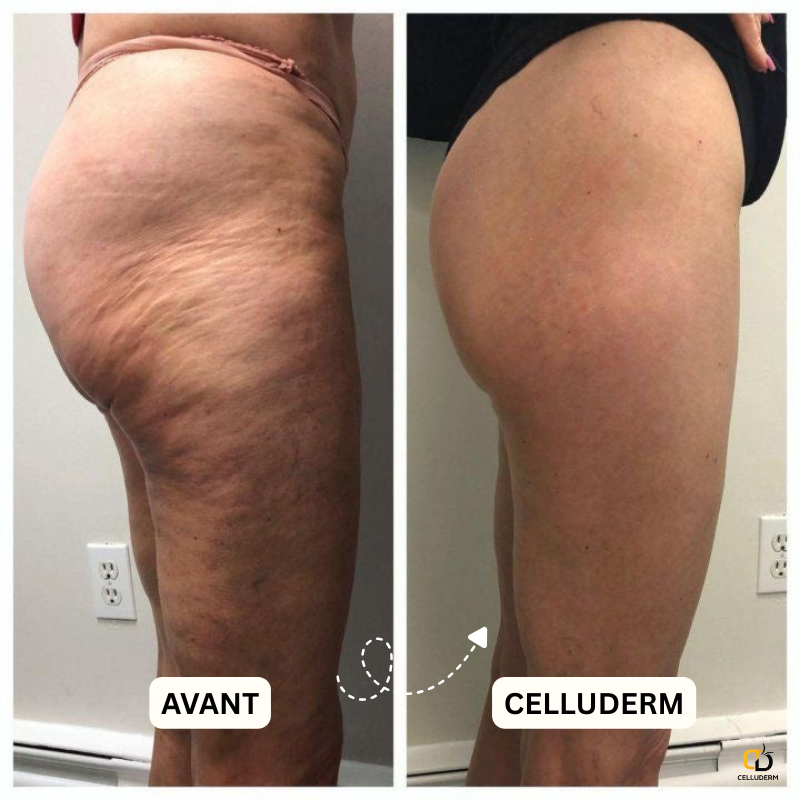 Derma+ Huile massage anti-cellulite